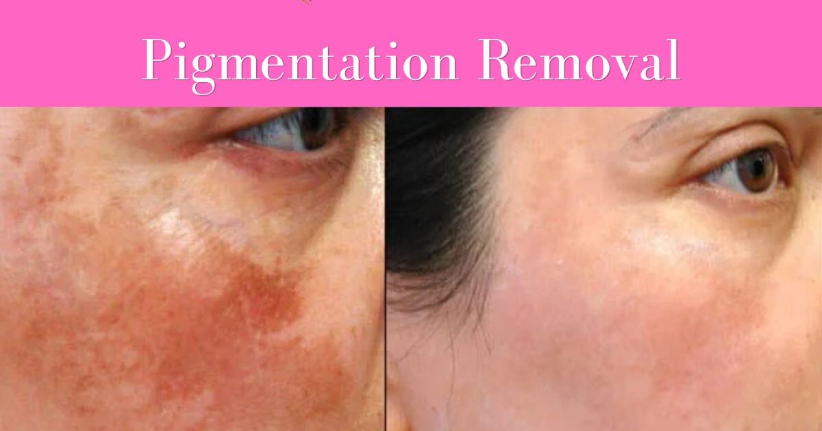 Pigmentation removal near me