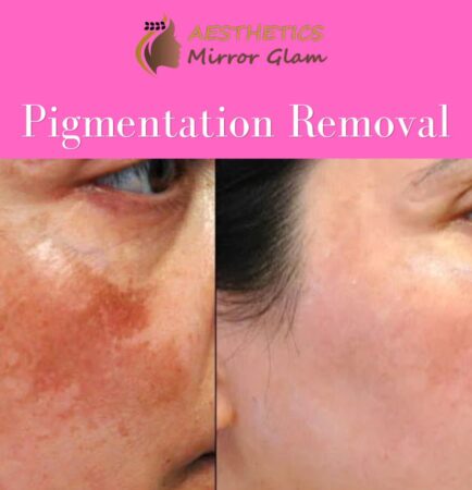 Pigmentation removal near me