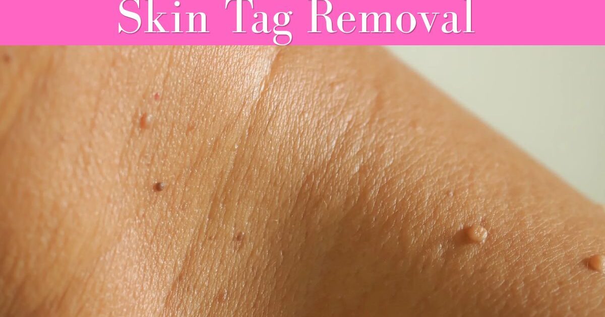 How to Remove Moles Naturally in One Day?