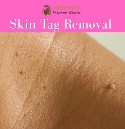 How to Remove Moles Naturally in One Day?