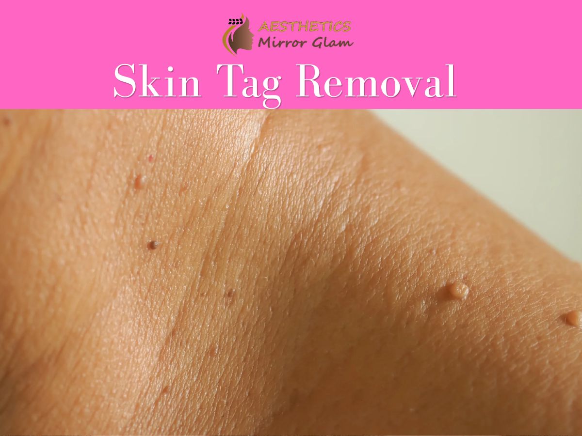 How to Remove Moles Naturally in One Day?