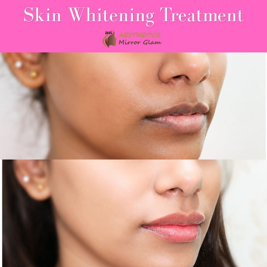 Skin whitening treatment delhi (1)