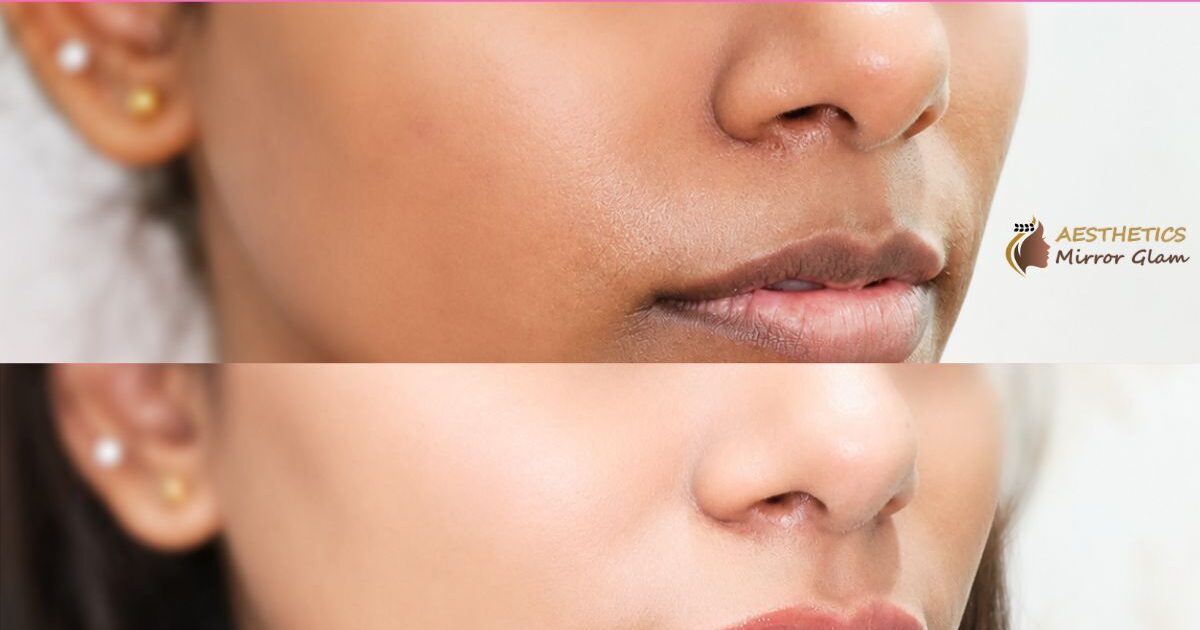 Skin whitening treatment delhi