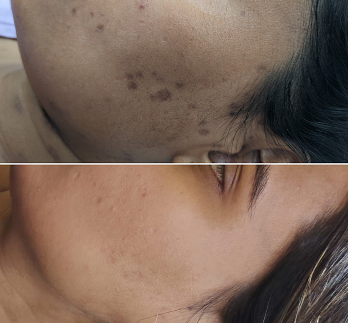 Laser Pigmentation Removal in Delhi