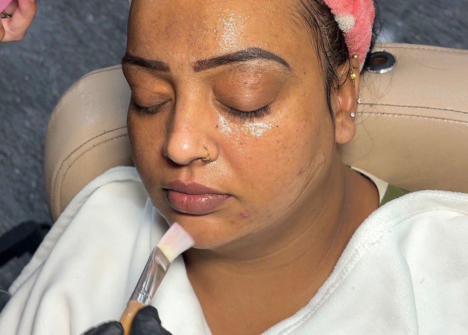 Chemical peel for acne scar