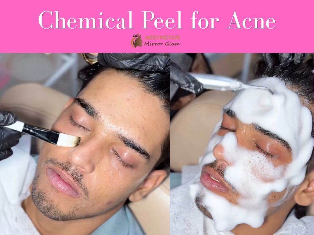 Chemical peel for acne and skin resurfacing in Rohini, Delhi