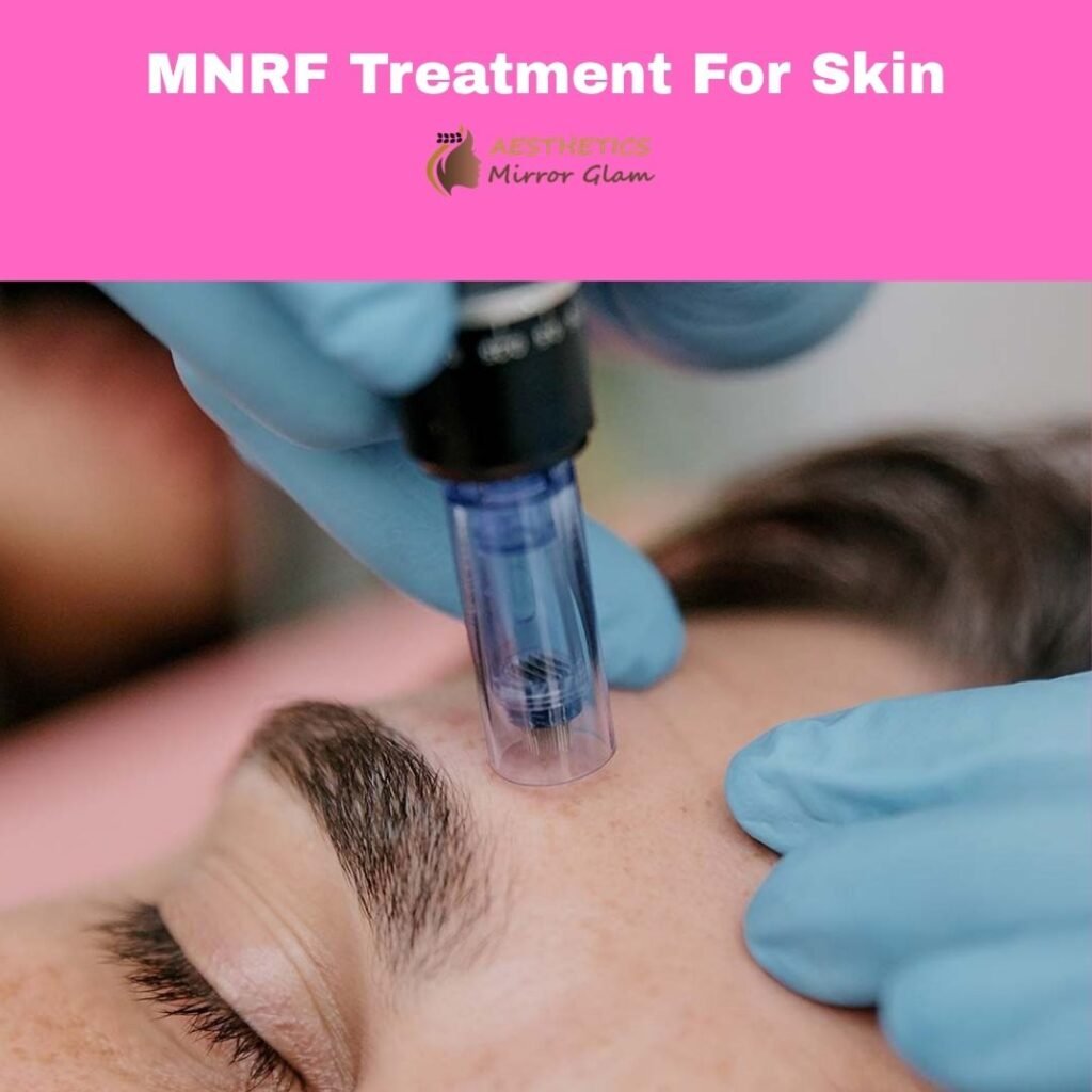 MNRF treatment for skin at Aesthetics Mirror Glam Studio, Rohini Sector 24