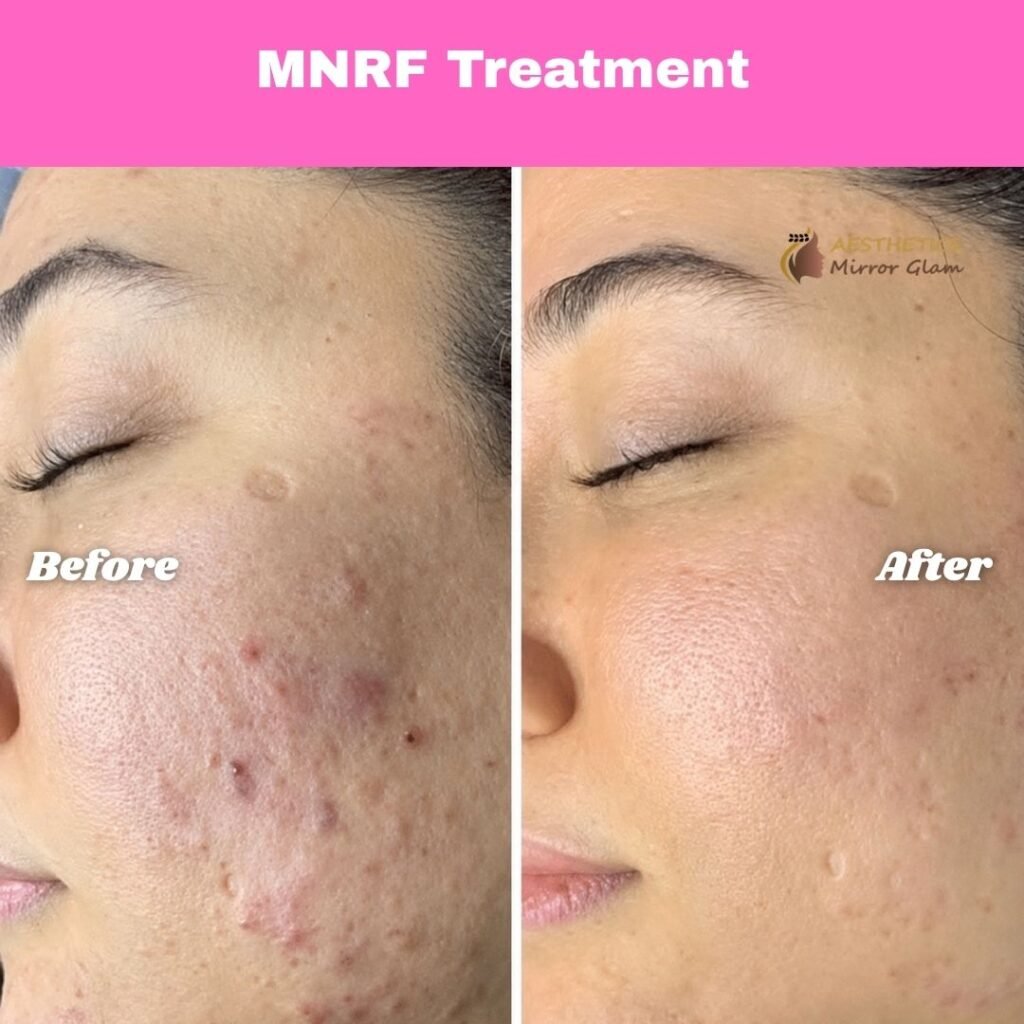 MNRF treatment before and after results at Aesthetics Mirror Glam Studio, Rohini