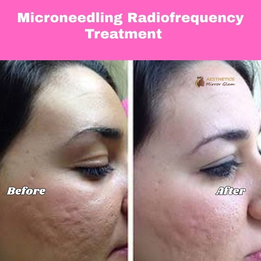 Microneedling radiofrequency MNRF before and after results at Aesthetics Mirror Glam Studio, Rohini