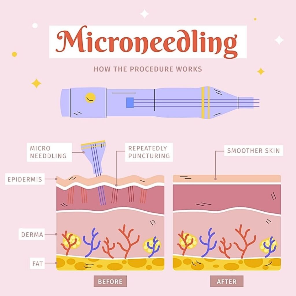 MNRF microneedling radiofrequency procedure at Aesthetics Mirror Glam Studio, Rohini