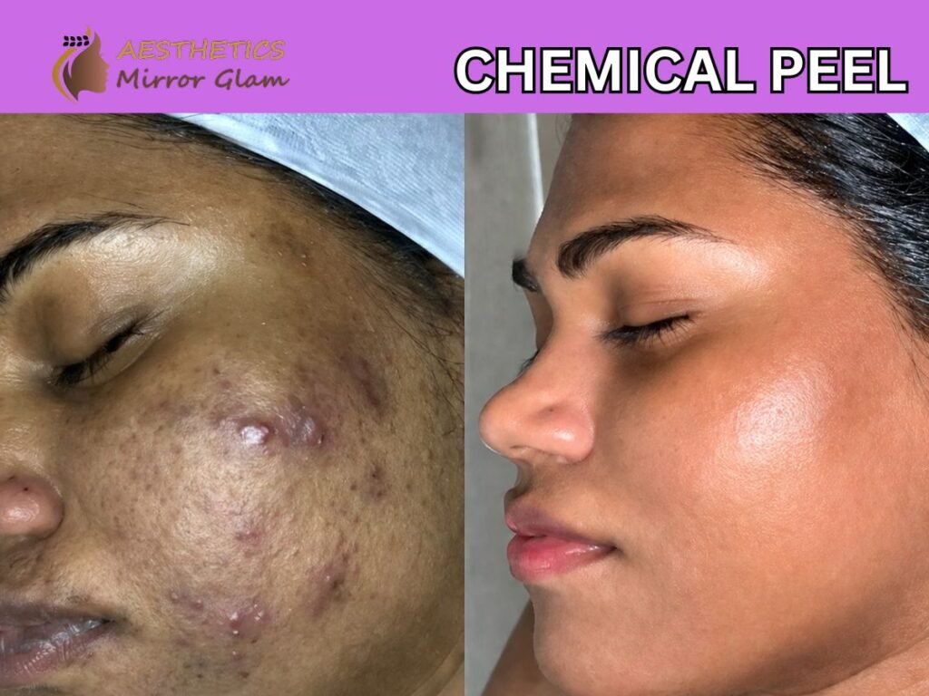 Chemical peel near me before and after at Aesthetics Mirror Glam Studio, Rohini