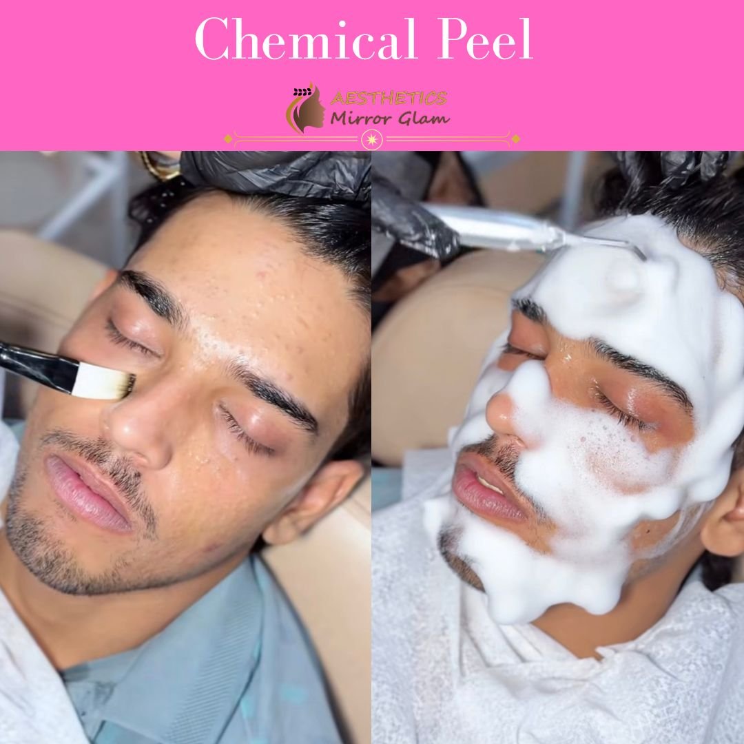 Chemical peel treatment in Rohini, Delhi at Aesthetics Mirror Glam Studio