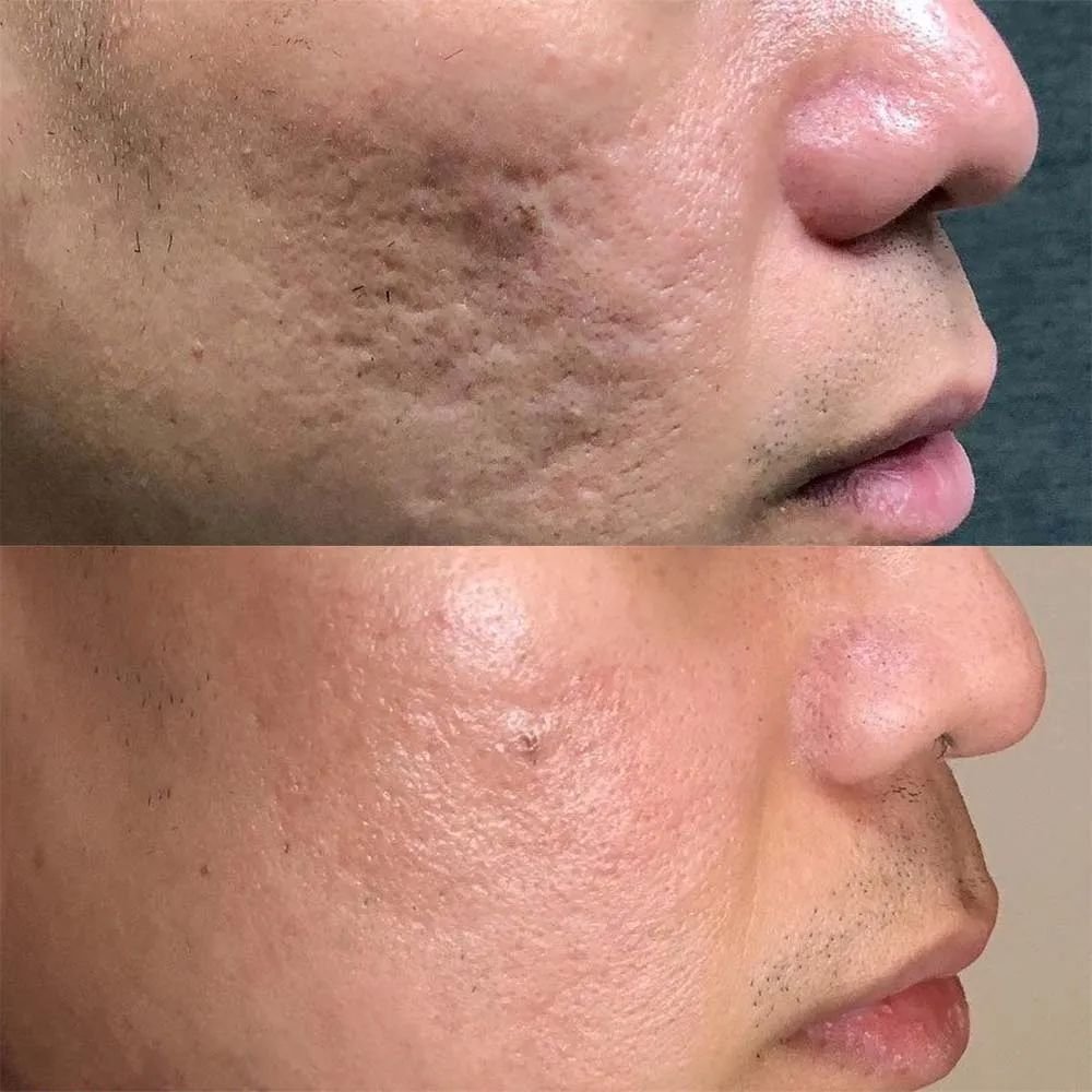 co2 laser acne scar treatment rohini