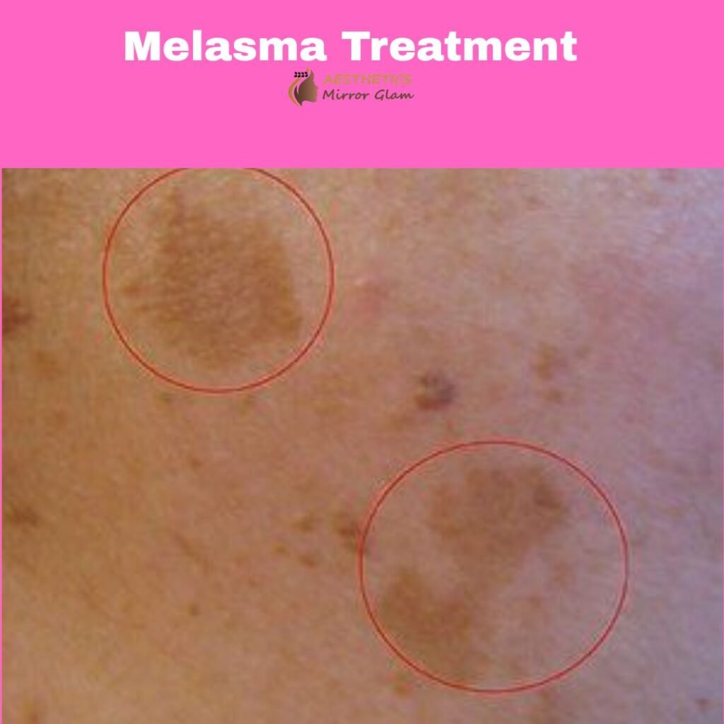 Best Melasma Treatment before after results at aesthetics mirror glam studio delhi india , do yu have the melasma on skin