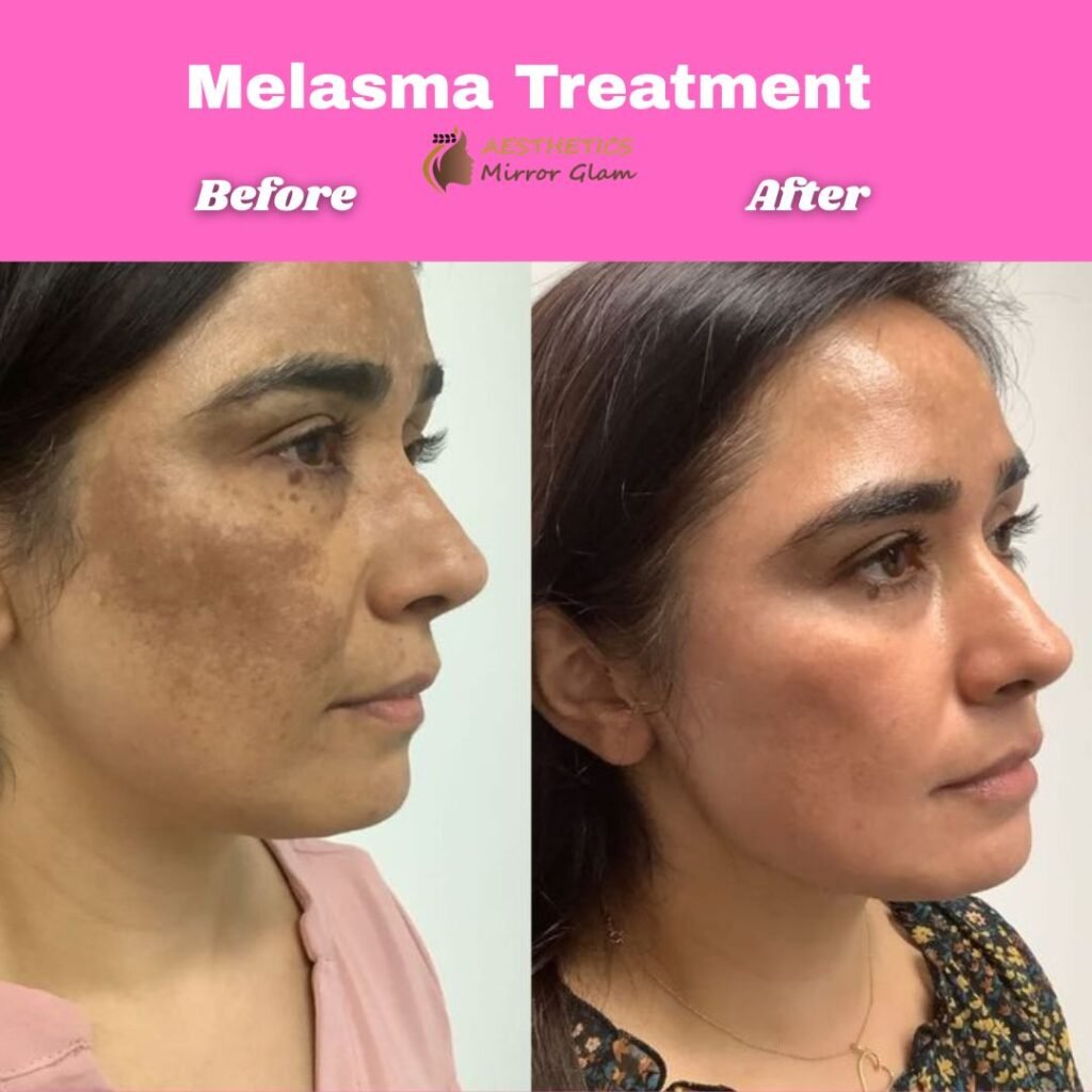 Best Melasma Treatment before after results at aesthetics mirror glam studio delhi india