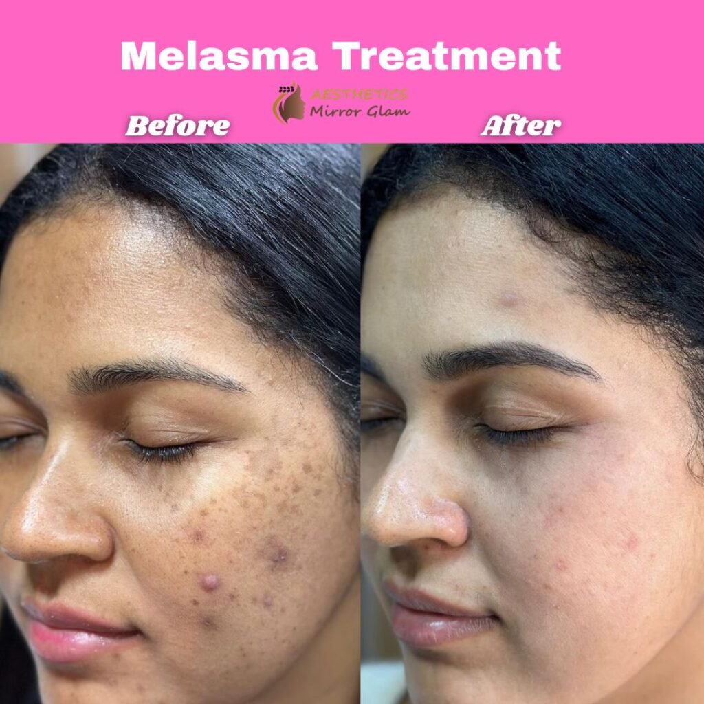 Best Melasma Treatment Studio in Delhi, India - Aesthetics Mirror Glam Studio