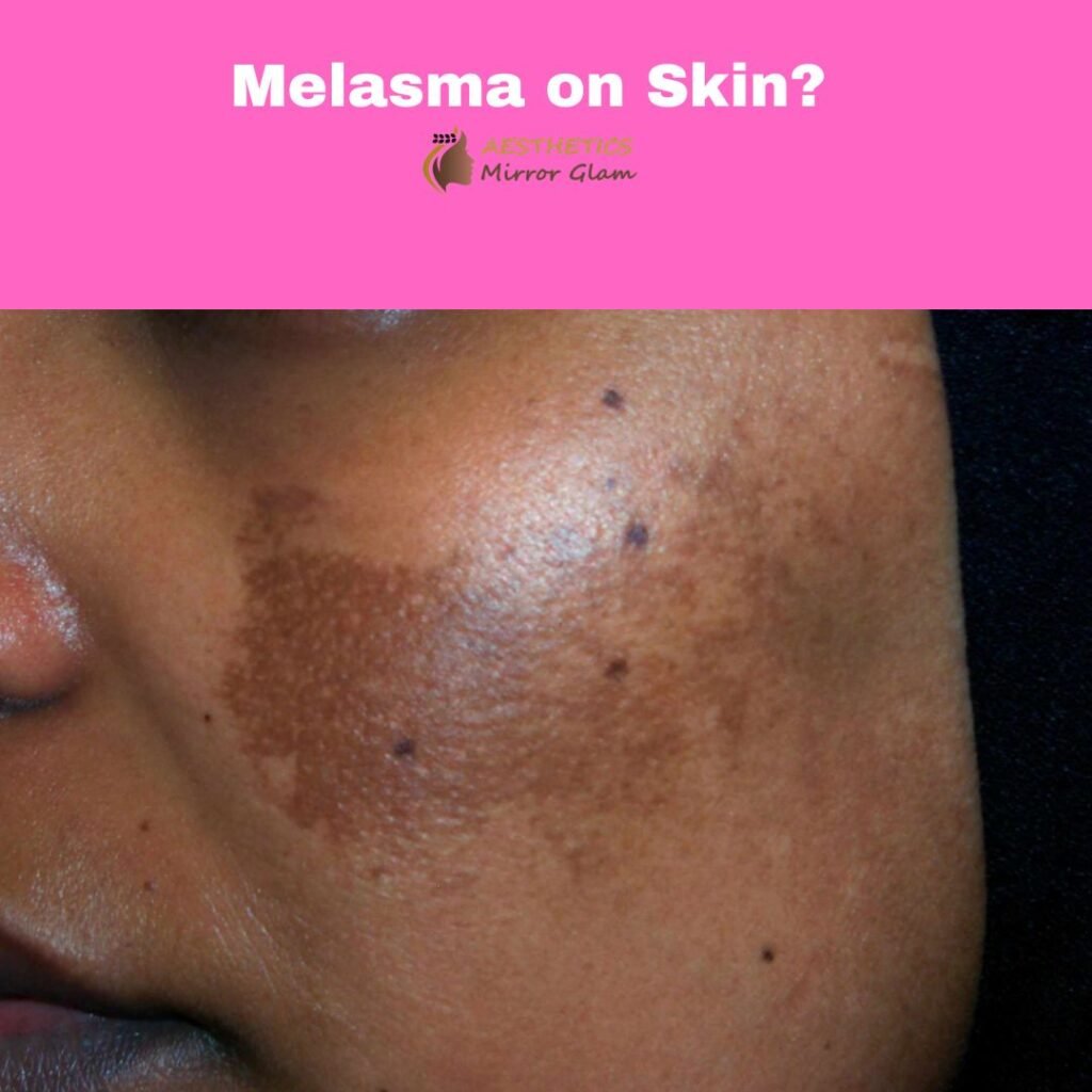 Best Melasma Treatment in Delhi, India - Facial Pigmentation Solution