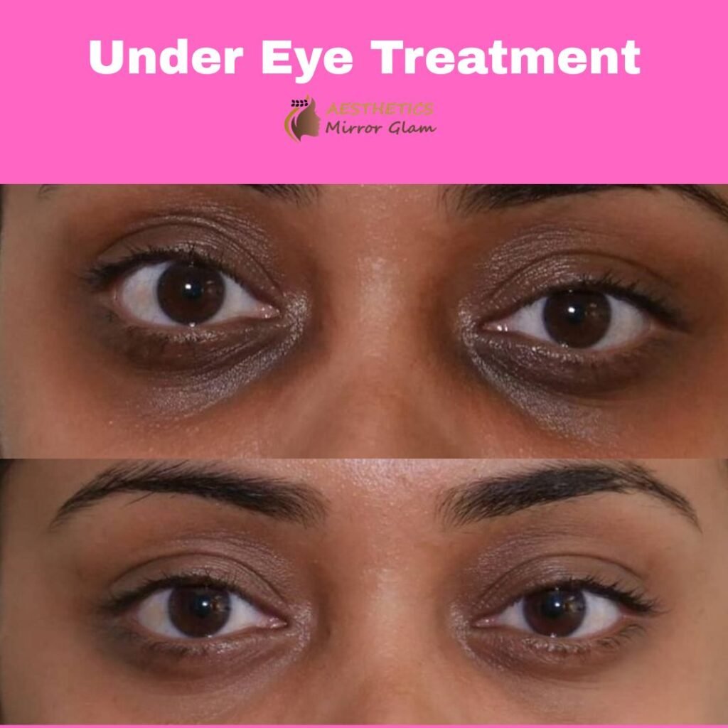 Under eye treatment near you in Rohini, Delhi at Aesthetics Mirror Glam Studio