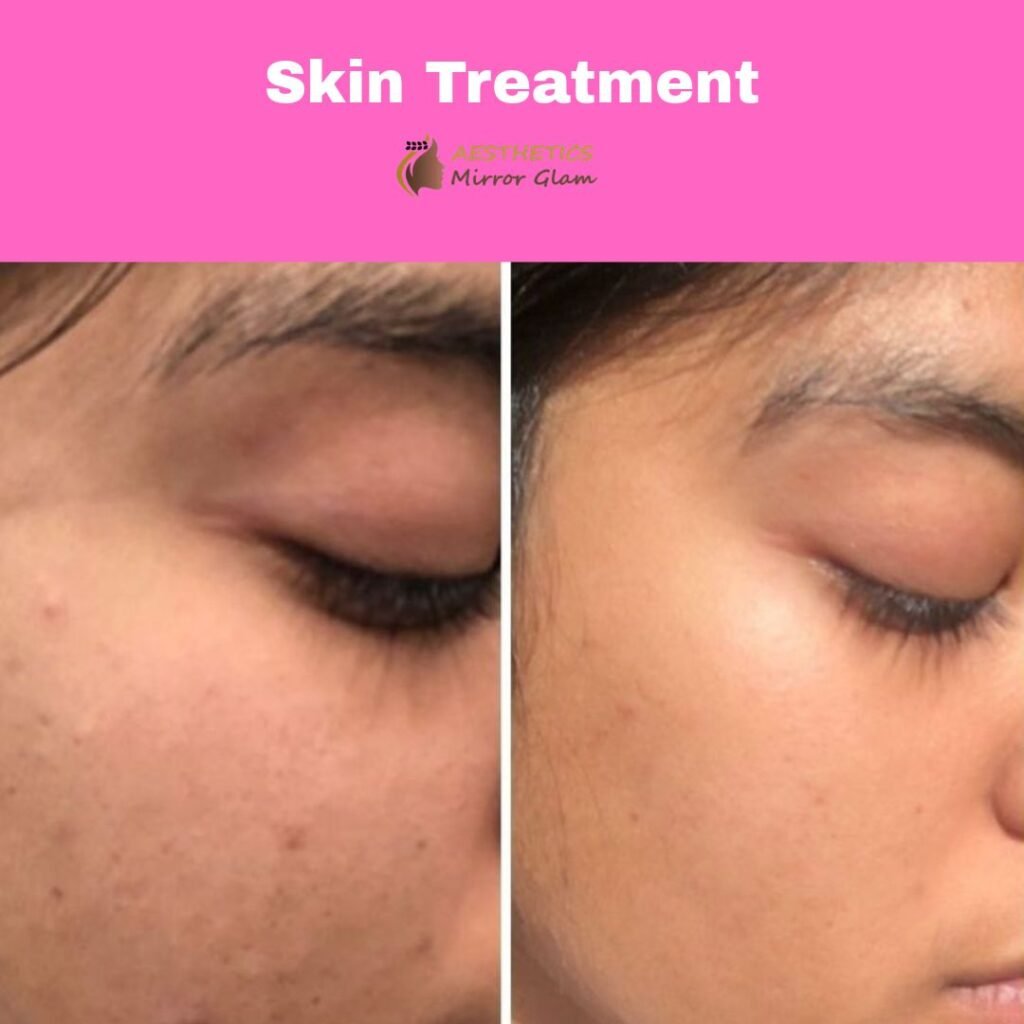 skin-treatment-rohini-delhi