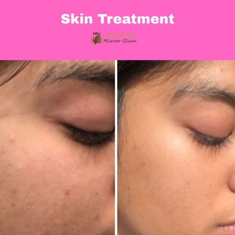 skin-treatment-rohini-delhi