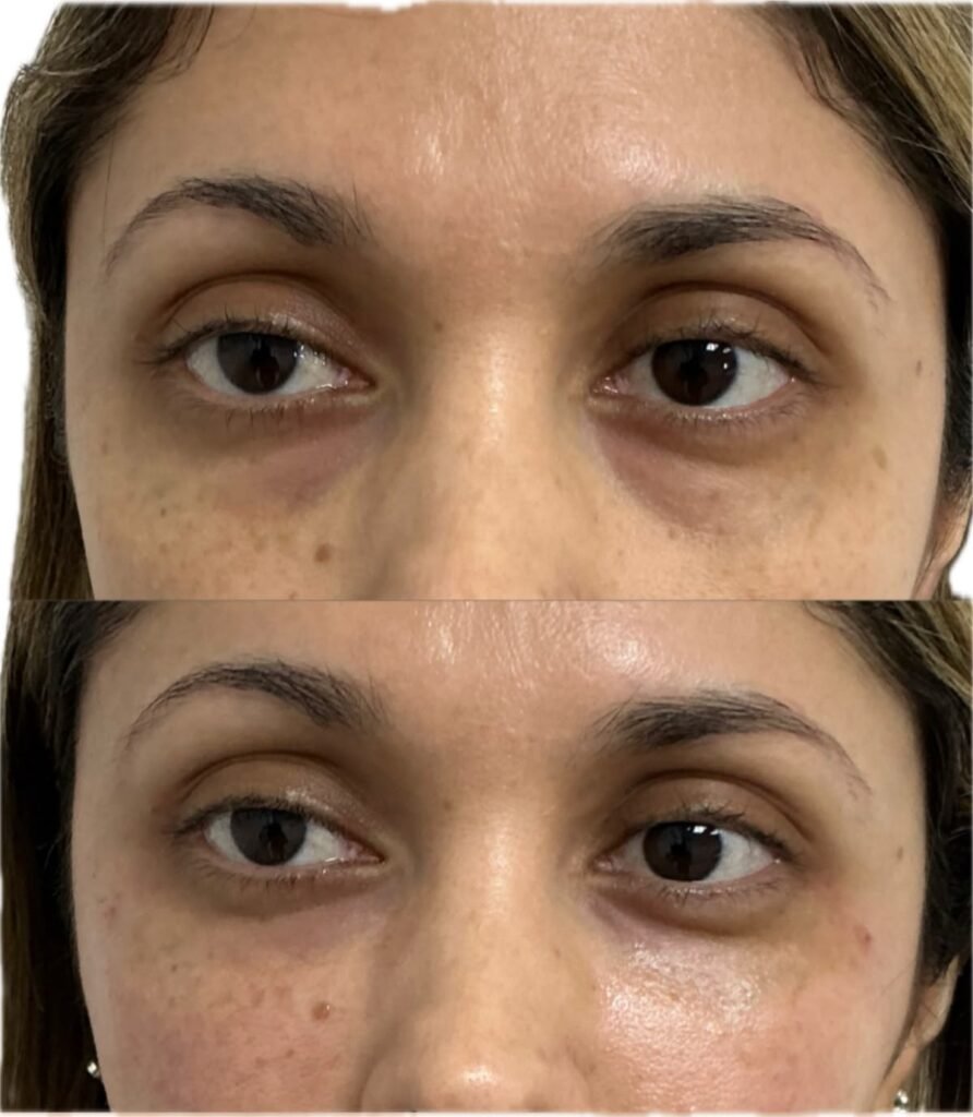 Under eye darkness removal in Rohini at Aesthetics Mirror Glam Studio