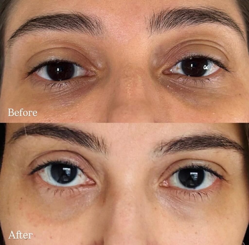 Under eye treatment in Delhi at Aesthetics Mirror Glam Studio